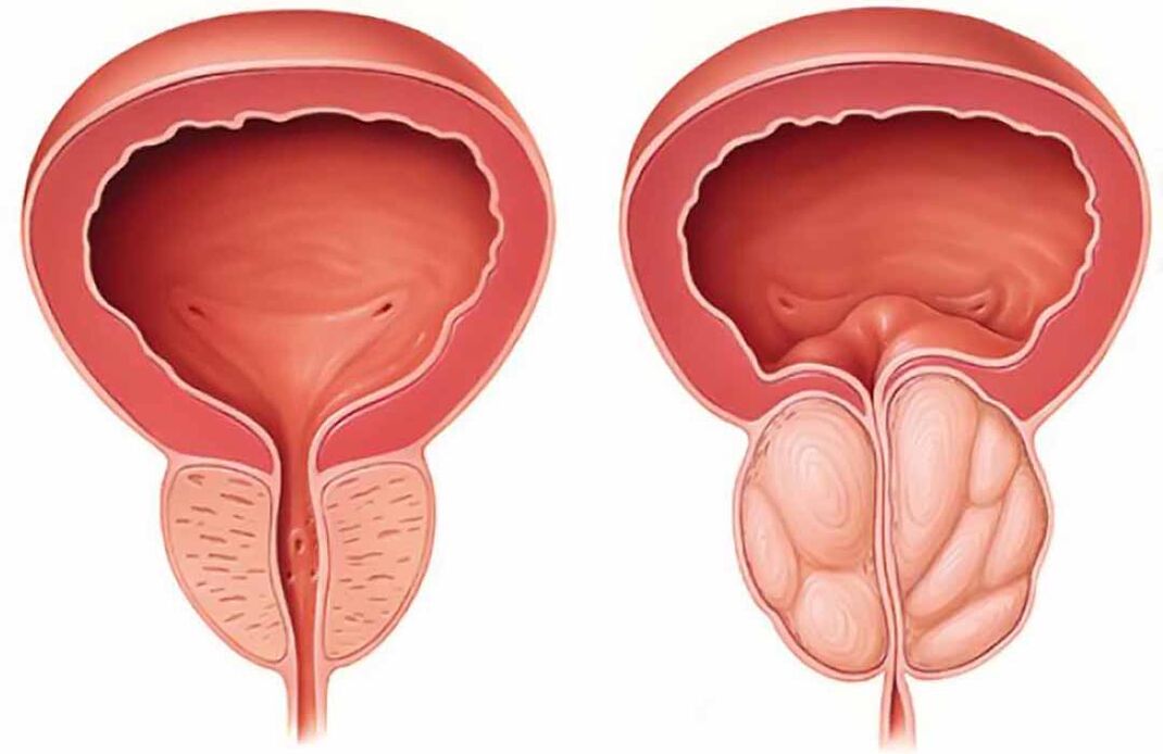 Normāla prostata un prostatas dziedzera iekaisums (hronisks prostatīts)