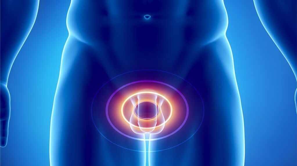 A prosztatitis ureteritis szövődménye. Prosztatagyulladás