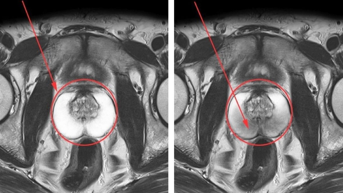Ultraskaņa hroniska prostatīta ārstēšanai – vesela prostata (pa kreisi) un iekaisusi (pa labi)