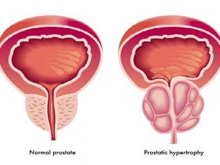 Normāla un iekaisusi prostata