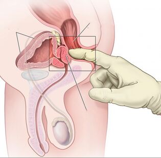 A prosztatitis ureteritis szövődménye, Dr. Diag - Urethritis chronica
