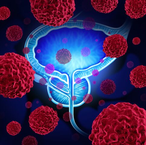 Patogēno mikroorganismu darbība ir prostatīta attīstības cēlonis