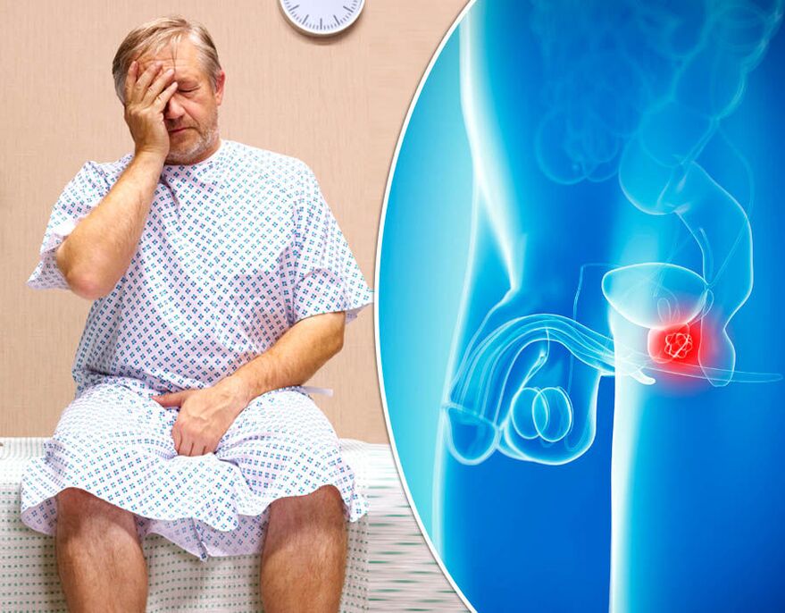 Vīrietim ar prostatītu tiek diagnosticēta slimība