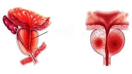 Kā izskatās hronisks prostatīts